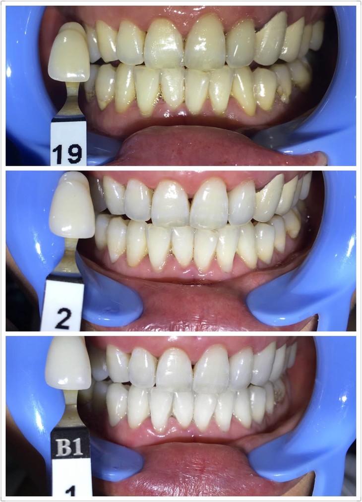 厦门种植牙专家推荐,技术精湛,口碑佳!(图1)