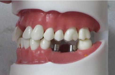 广州市牙科种植:选对医院,享受专业服务(图1)