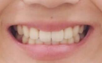 银川市口腔医院怎么样?内附价格表及案例(图3)