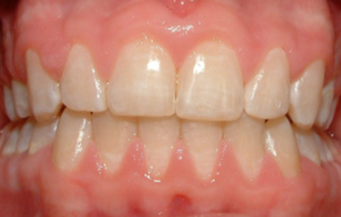 益阳市口腔医院怎么样？内附案例及价格表(图3)