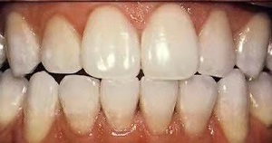 义乌拜博口腔医院怎么样?内含价格表及案例分析(图3)