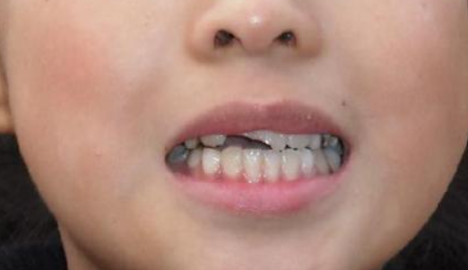 越秀区口腔医院怎么样？内附价格表及牙齿种植案例欣赏(图2)