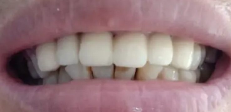 越秀区口腔医院怎么样？内附价格表及牙齿种植案例欣赏(图3)