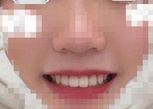 岳池口腔医院正规吗?能不能做牙齿种植项目?医院介绍附案例和价格表!(图4)