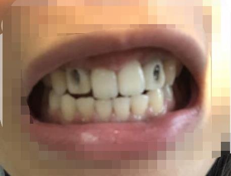 岳池口腔医院正规吗?能不能做牙齿种植项目?医院介绍附案例和价格表!(图3)