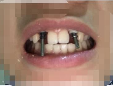 岳池口腔医院正规吗?能不能做牙齿种植项目?医院介绍附案例和价格表!(图2)