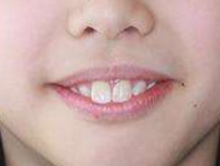 玉蕙口腔医院怎么样?内附案例及价格表(图2)