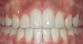 优伢仕口腔医院怎么样？内附案例及价格表(图3)