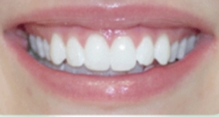 优诺博士口腔医院怎么样？附案例分析和价格表(图3)