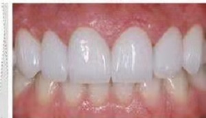 永康口腔医院价格表?术后效果好不好?内含案例分析(图3)