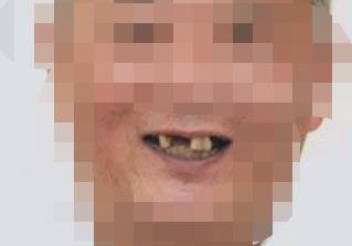 永川拜博口腔医院做种植牙好吗？医院介绍附案例和价格表！(图2)