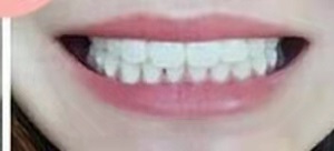 隐形牙套矫正多少钱唯问国贸口腔？影响价格的因素是什么？内含价格表及案例(图3)