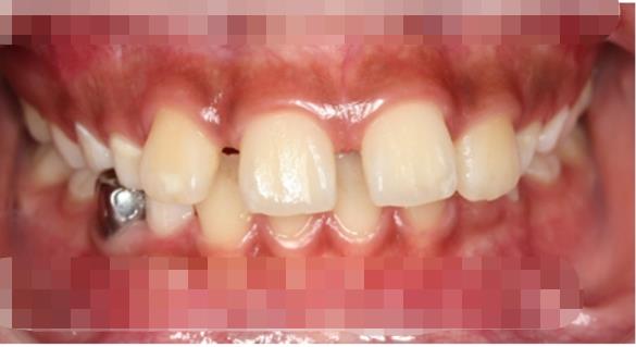 鄞州口腔医院做牙齿矫正贵不贵,医院介绍附案例价格表!(图2)