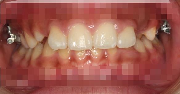 鄞州口腔医院做牙齿矫正贵不贵,医院介绍附案例价格表!(图3)