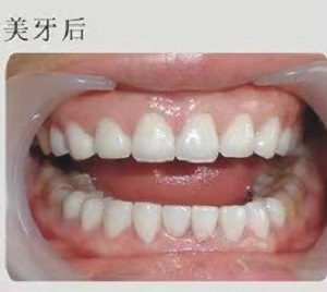 鄞州儿童口腔医院怎么样?内含价格表及案例分析(图3)