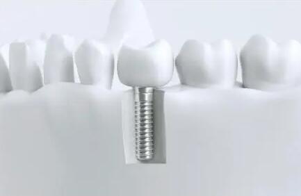 医院口腔科种植牙价格标准速览2023年种牙价格已更新(图1)