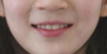 阳光树口腔医院怎么样？内附案例及价格表(图3)