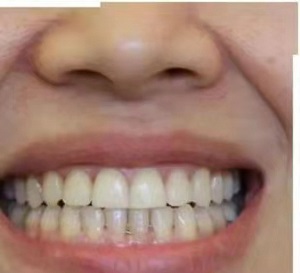 燕郊靓美口腔医院贵吗怎么样?内含价格表及案例分析(图3)