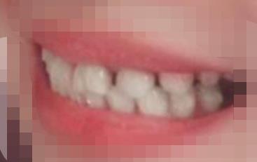 延吉韩北口腔诊所怎么样,能做牙齿矫正吗?附案例和价格表!(图3)