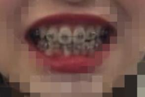 延吉韩北口腔诊所怎么样,能做牙齿矫正吗?附案例和价格表!(图4)