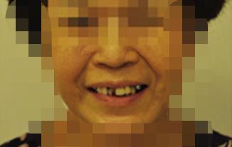 延安小白兔口腔医院怎么样?做牙齿种植项目好不好?医院介绍附案例和价格表!(图2)