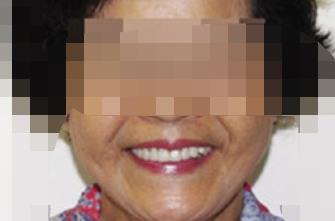 延安小白兔口腔医院怎么样?做牙齿种植项目好不好?医院介绍附案例和价格表!(图3)