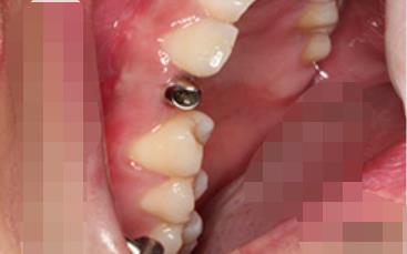 延安小白兔口腔医院怎么样?能做种植牙吗?医院介绍附案例分享和价格表!(图2)