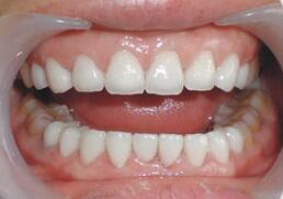 烟台顺达口腔医院是正规的吗？做洗牙什么样，洗牙前后效果对比附最新价格表！(图3)