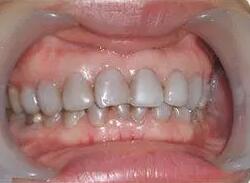 烟台顺达口腔医院是正规的吗？做洗牙什么样，洗牙前后效果对比附最新价格表！(图2)