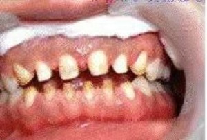 烟台口腔医院莱山分院怎么样?内含价格表及烤瓷牙案例分析(图2)