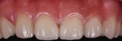 雅美口腔医院怎么样?内附案例及价格表(图3)