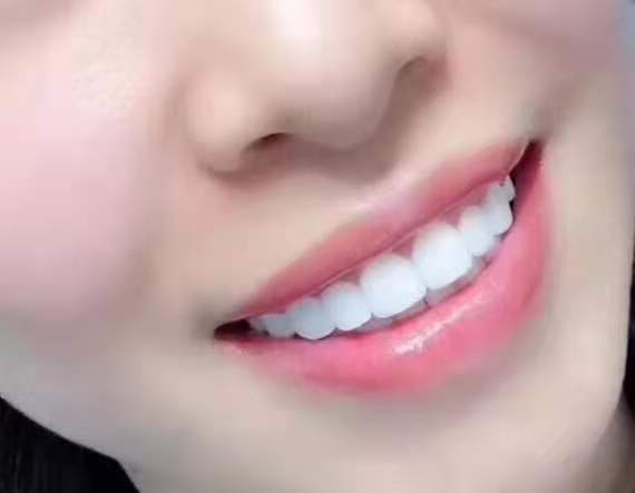 雅度口腔医院怎么样?附牙齿美白案例分析和价格表查询(图3)