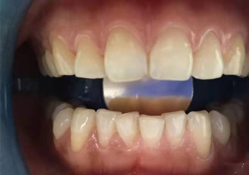 雅度口腔医院怎么样?附牙齿美白案例分析和价格表查询(图2)