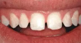 雅度口腔矫正牙齿要多少？地址价格(图2)