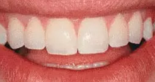 雅度口腔矫正牙齿要多少？地址价格(图3)