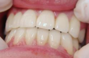 雅贝康口腔医院怎么样？内附案例及价格表(图3)