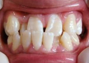 雅贝康口腔医院怎么样？内附案例及价格表(图2)