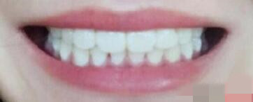 雅贝康口腔医院怎么样?附案例分析和价格表(图3)