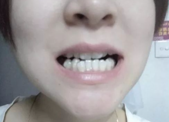 雅贝嘉口腔医院怎么样？牙齿矫正案例分享_价格表参考_乘车路线(图2)