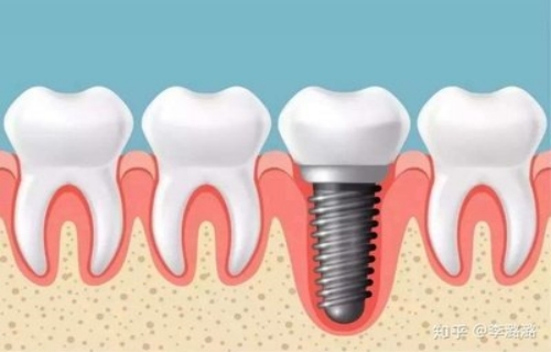 牙先森口腔(大丰店)种植牙价格了解,种植牙排名以及护理方法!(图2)