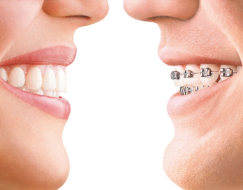 奥美科托槽哪个国家的-今日口腔科普:奥美科ormco金属自锁托槽牙套(图1)