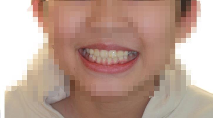 宁波口腔医院和海曙口腔医院哪个好?两家医院介绍附牙齿矫正案例和价格表!_2(图3)