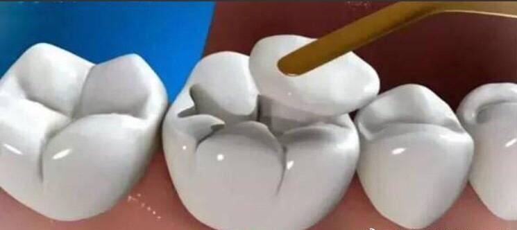 牙龈萎缩怎么治疗(图2)