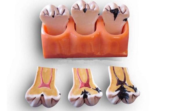 智齿是怎么形成的—智齿是怎么形成的呢(图2)