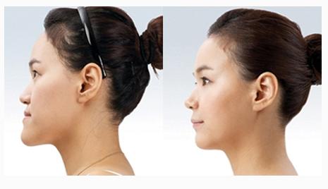 地包天怎么形成的,地包天怎么形成的?(图3)