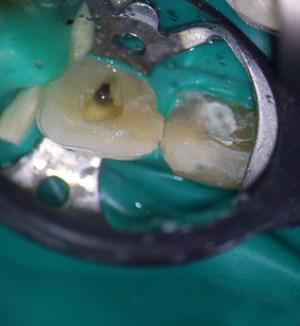 牙齿发炎怎么治疗;牙齿发炎怎么治疗吃盐(图2)