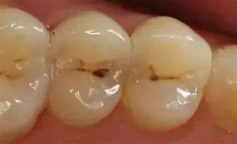 牙齿酸酸的怎么回事-较近牙齿酸酸的怎么回事