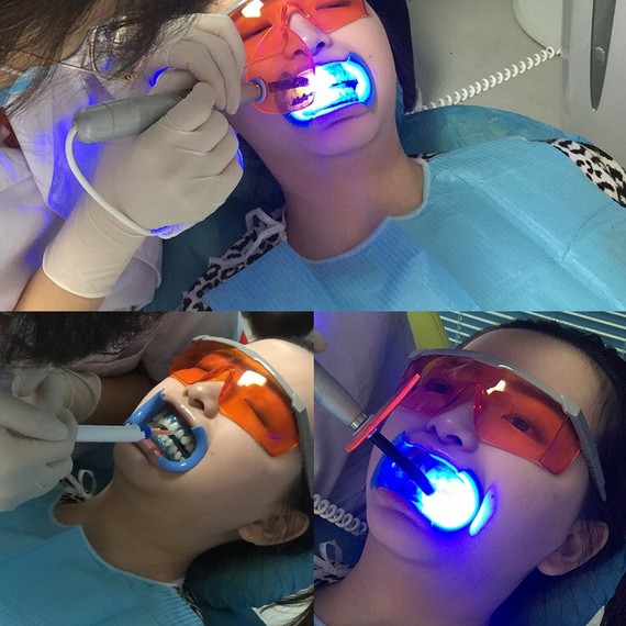 牙齿门牙缝隙大怎么办;牙齿门牙缝隙大怎么办35岁