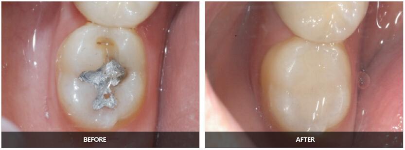 牙齿有个洞怎么办，牙齿有个洞怎么办不痛(图2)