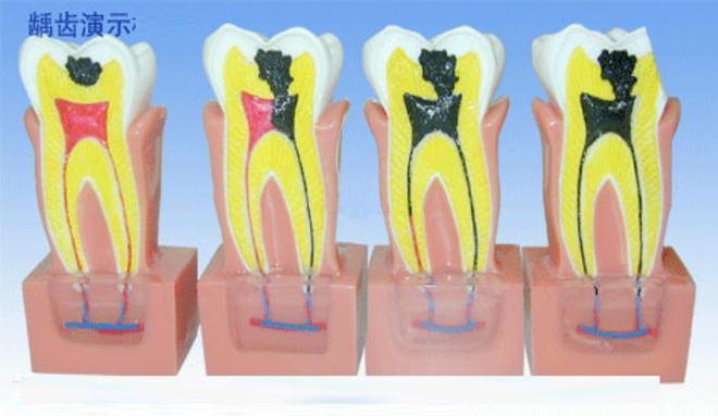 牙齿神经痛怎么治_牙齿神经痛怎么治较彻底